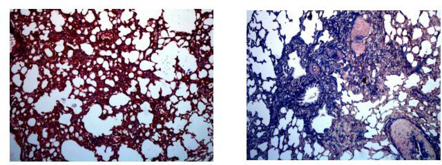 肺纤维化模型示意图